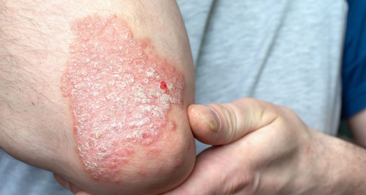 Luskavica pogosto spremljana s srčno-žilnimi in drugimi boleznimi